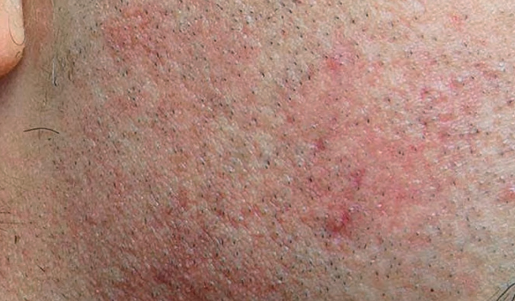 Razor Burn from Electric Shavers